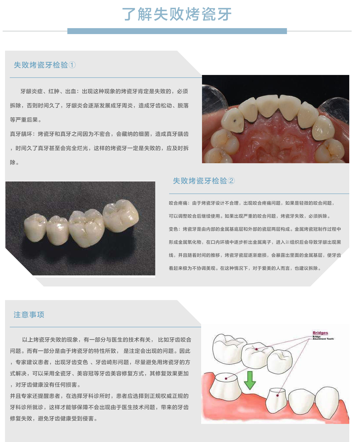 数字化种植中心失败烤瓷牙.jpg