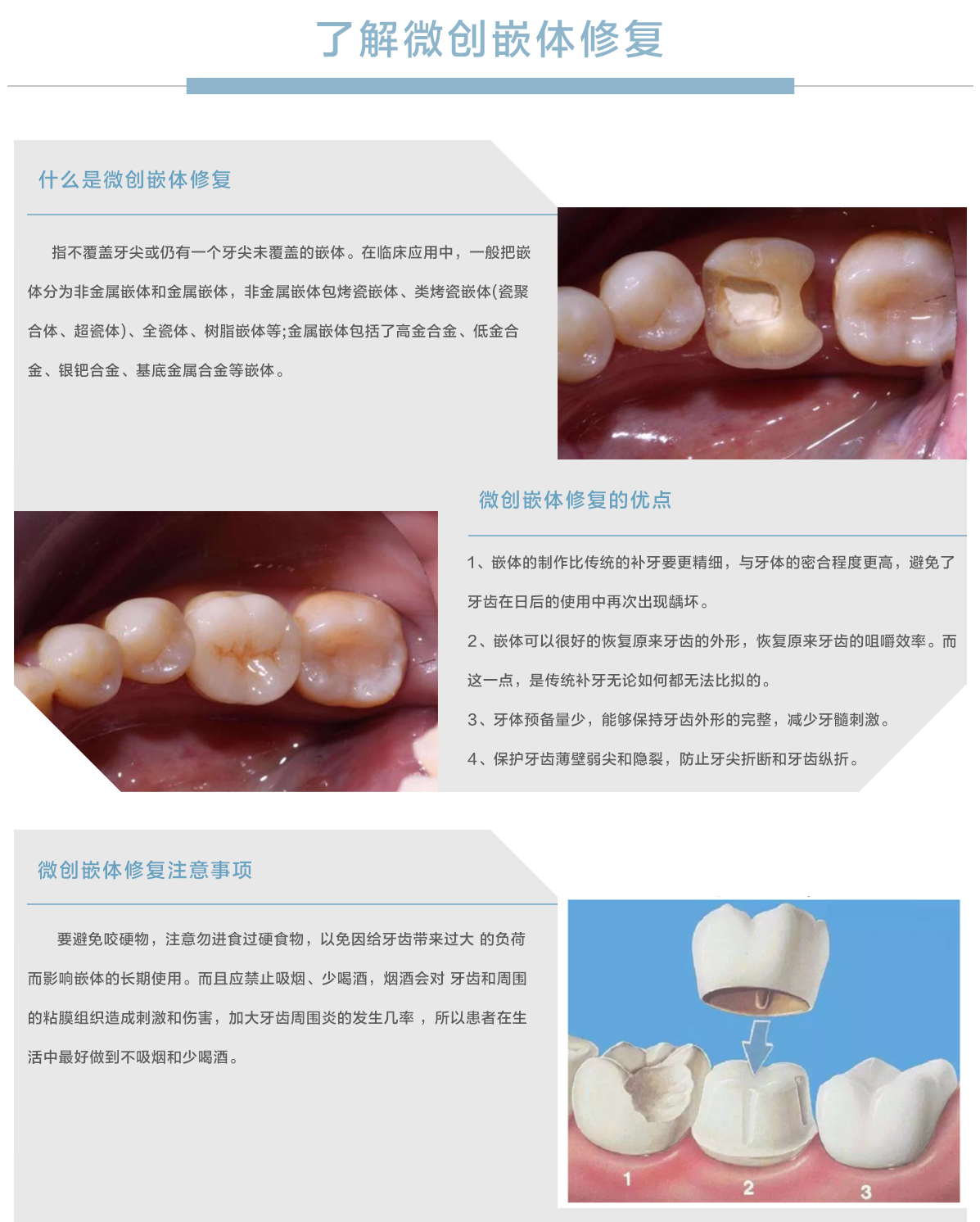 牙齿美学中心微创嵌体修复.jpg